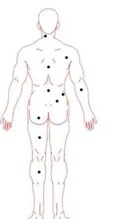 男人背部痣相图解