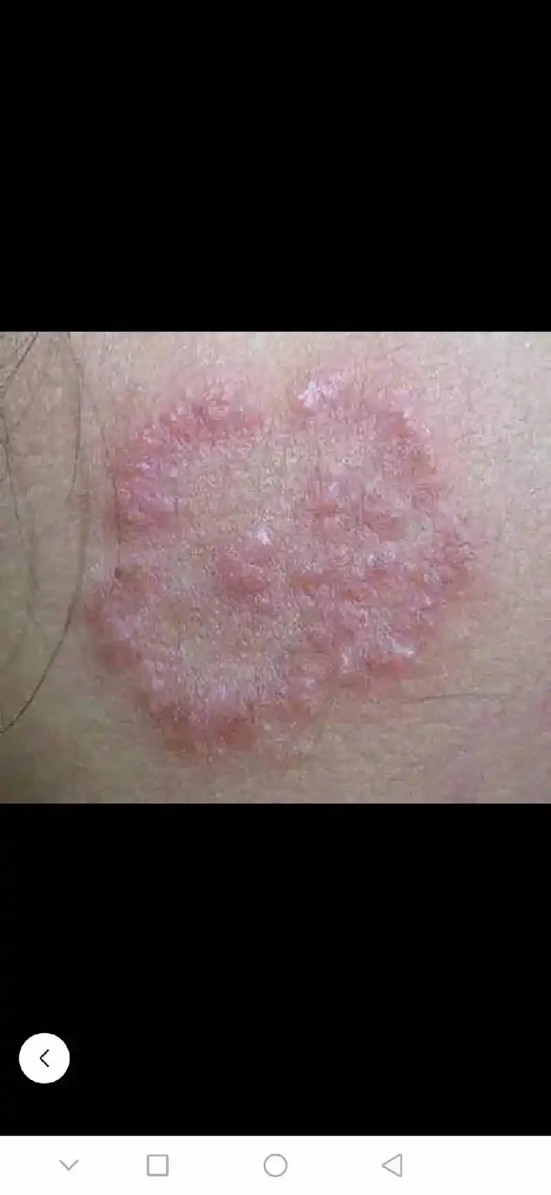 凡事身上有长这种顽固性皮肤病的,到处买药搞不好的,有药膏整他 - 抖