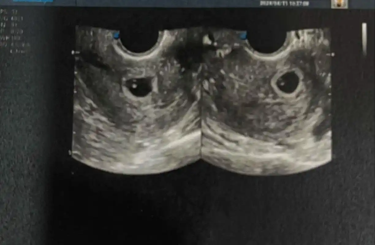 我的宝宝出胎心胎芽啦#接一切好孕 #一个身体两个心跳 #猜男 - 抖音