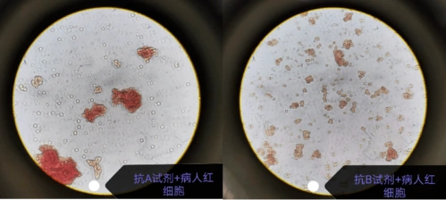 血型正反定型 abo 都出现凝集?_手机搜狐网