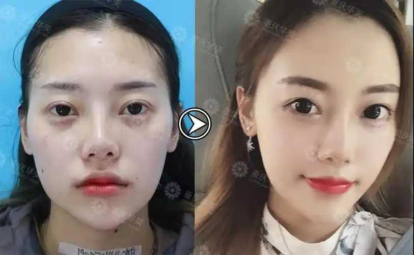 脂肪填充对比图