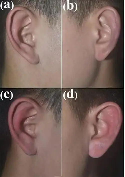 一发病就耳朵红肿痛这种罕见怪病被专家用秘籍治好了