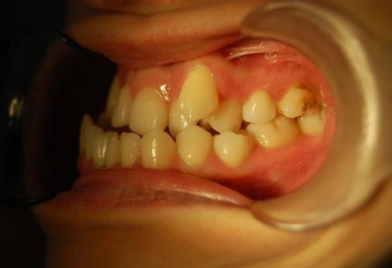 拔虎牙后的面容图片8