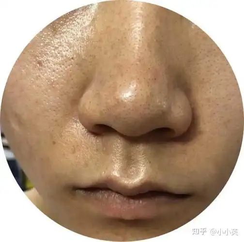 油皮毛孔粗大的人该如何控油护肤?