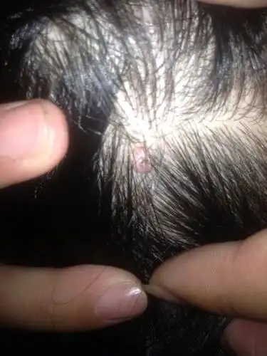 头上长了几个肉疙瘩,软的,最近有一个明显长大了,请问这样的肉疙瘩是