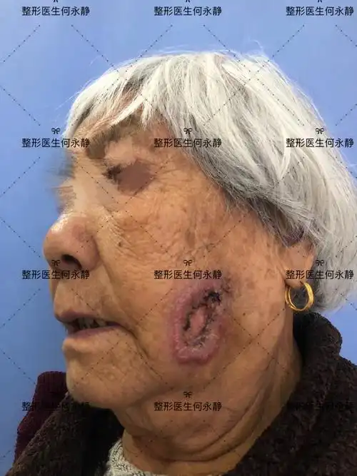 皮肤溃疡不愈合要警惕_皮肤癌_皮肤癌症状表现 - 好大夫在线
