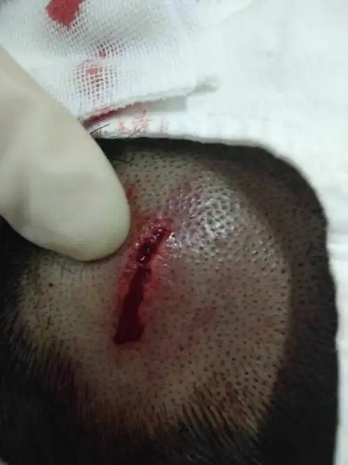 头部伤口3.5公分,宽0.5厘米,深见骨,如果法医鉴定算哪种伤害?轻伤?