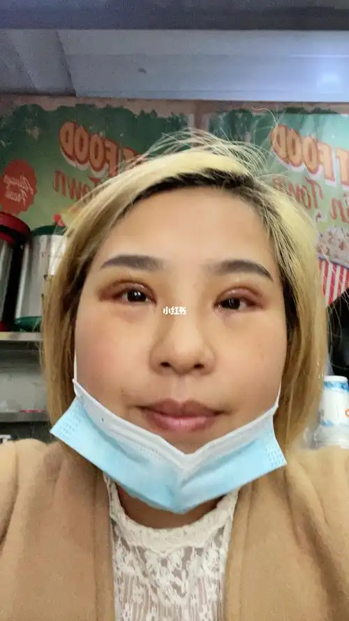 双眼皮手术第七天刚刚拆线回来眼睛大小不