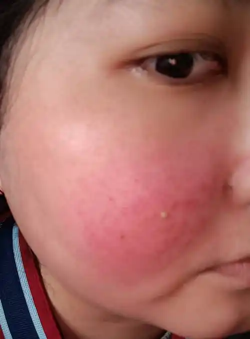 皮肤发红发烫-系统性红斑狼疮康复圈-觅健