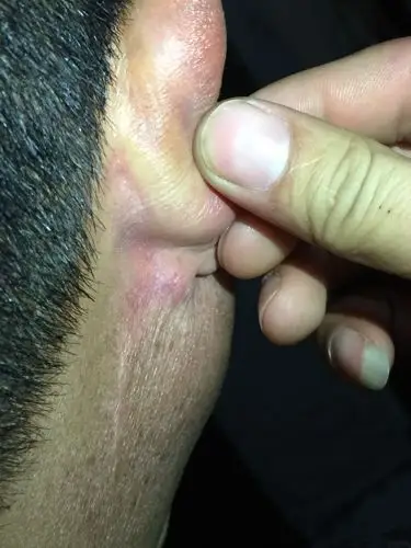 爸爸今年上半年做了腮腺瘤手术,现在耳后又长了一个小疙瘩,摸起来像个