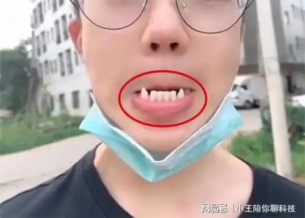 17岁男孩长尖牙,妈妈吐槽像"吸血鬼",网友:被咬一口很难辨别