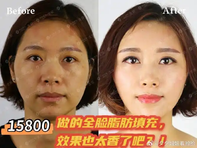 15800做的全脸脂肪填充,也太香了吧?