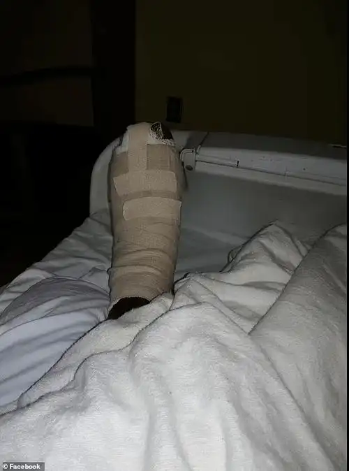 美国女子做美甲感染细菌截肢小腿才保命店家赔1170万