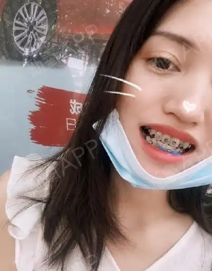 从小时候换牙后虎牙就特别突出.本来从来没想过矫_圈子-新氧美容整形