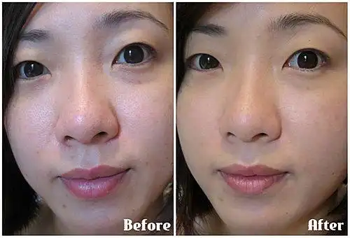 打美白针有副作用吗