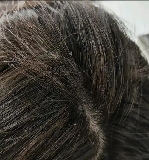 头皮痒,头屑多,还容易油怎么办? - 知乎