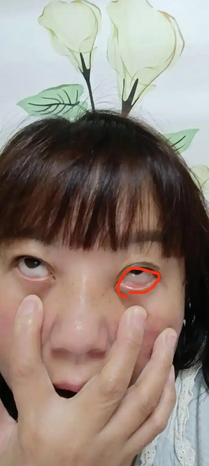 今晚突然发现眼睛里长东西了称还没有瞎敢紧拍两张图片做个留恋