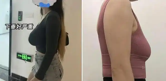 运动时"抖胸"会让胸部下垂不可逆?运动内衣真的要穿专业的才行!