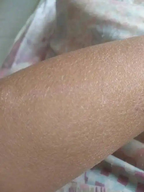 胳膊腿上有干皮