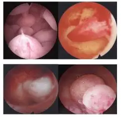 长在子宫里的多肉陈晶医生谈子宫内膜息肉那些事儿