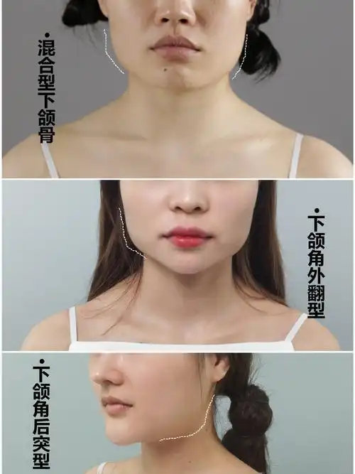 99第二种,下颌角外翻型;正面脸型变宽.