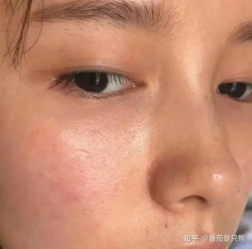 经常熬夜皮肤越来越差怎么办?