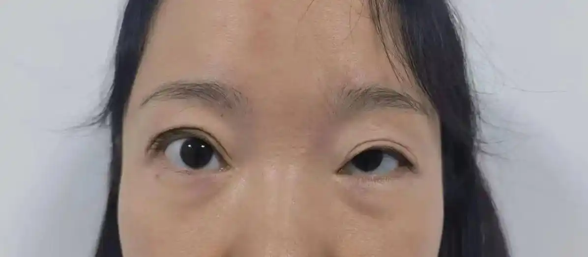 左侧重度上睑下垂额肌瓣修复,右侧重睑内侧调整 照片分别为术前 - 抖
