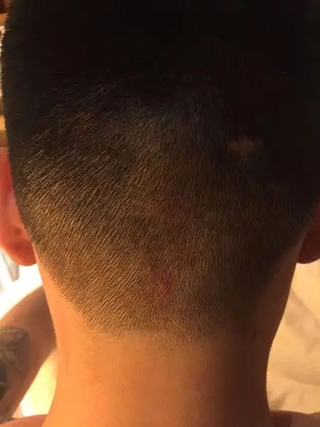 这是什么原因啊后脑勺头皮发红而且还经常起小痘痘