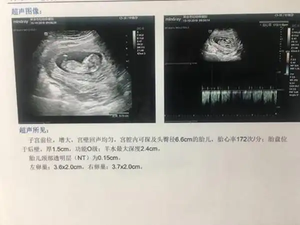 生男生女早就注定了的事情,奉劝孕妈妈们要放宽心,即便胎儿宝宝的性别