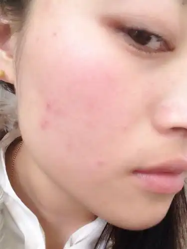 最近脸部毛孔堵塞,不通透,痘痘粉刺不断!是内分泌哪失调了吗