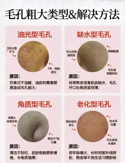 毛孔粗大4大分类你属于哪一种