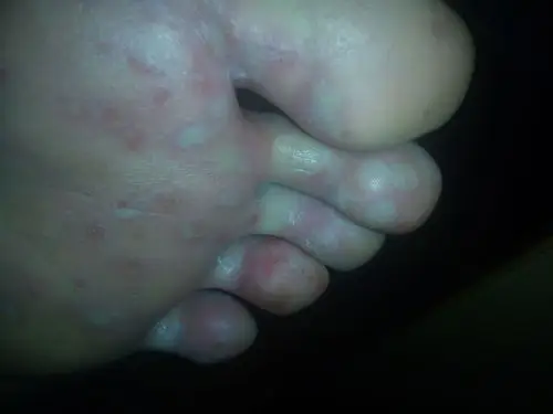 我的脚底板长了很多一粒粒白白的像水泡很痛