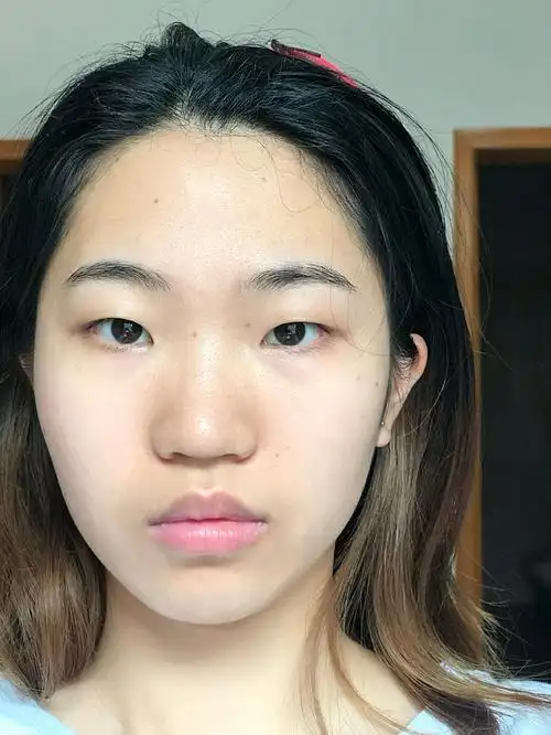 我以前的鼻子,就是这种扁扁的,平平的.鼻梁也不挺,_圈子-新氧美容整形