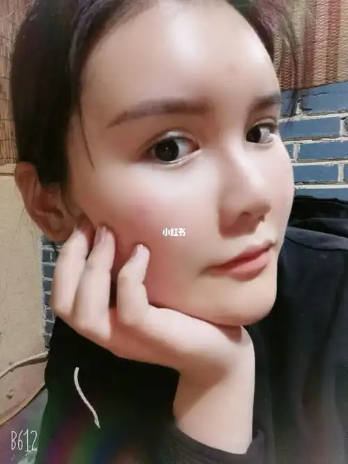 自体脂肪填充全脸第十一天啦_减肥_自体脂肪面部填充_美妆_医美整形