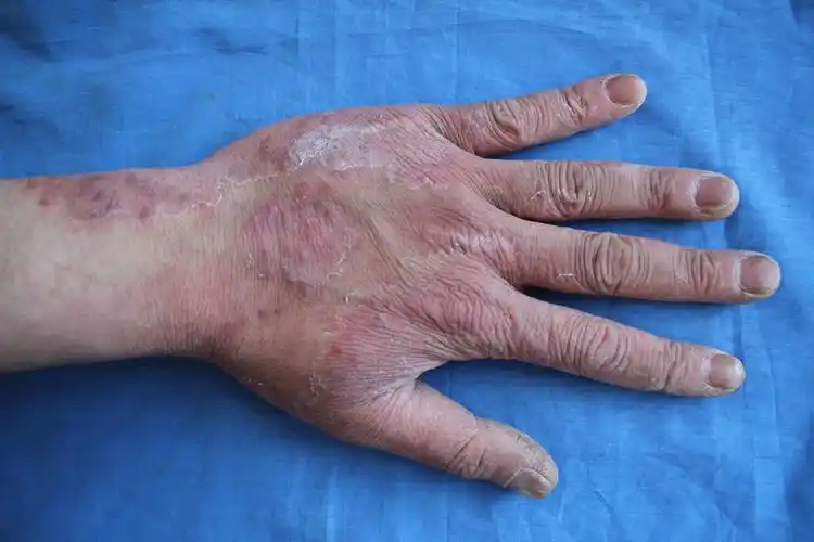 手癣一例