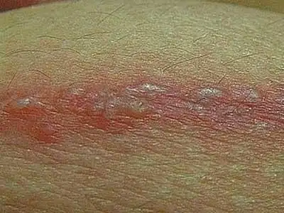 促使带状疱疹疾患生发的诱因_带状疱疹是怎么引起的_青岛皮肤病研究院