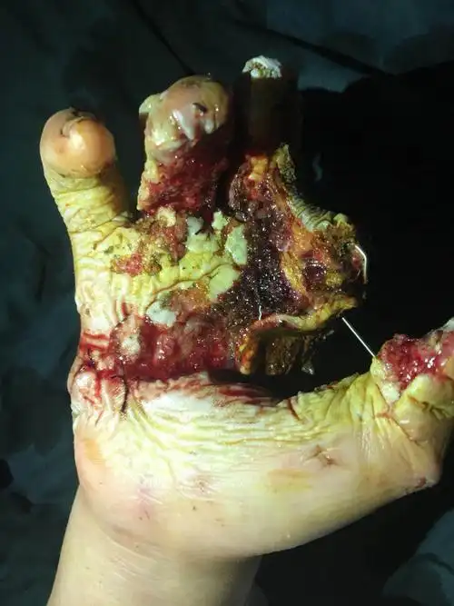 二次行手掌创面修复前情况,坏死组织界限已清楚,创面感染已得到控制.