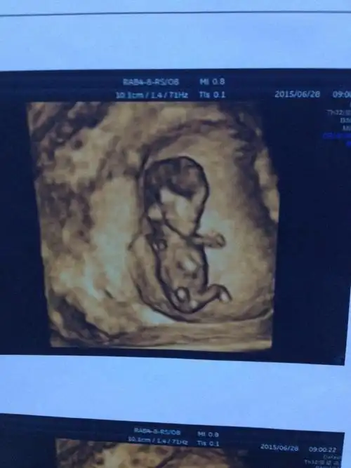这是三个多月时候四维彩超的.