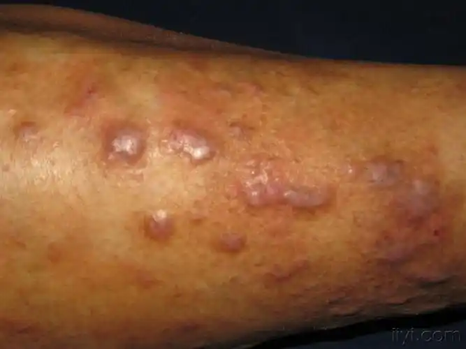 看图识病······右小腿骚痒性斑块 - 皮肤及性传播疾病讨论版