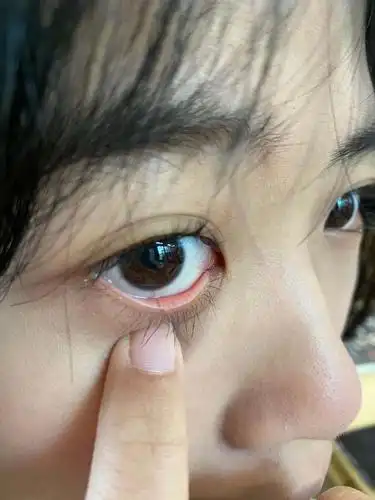 下眼睑长了个小颗粒要怎么办