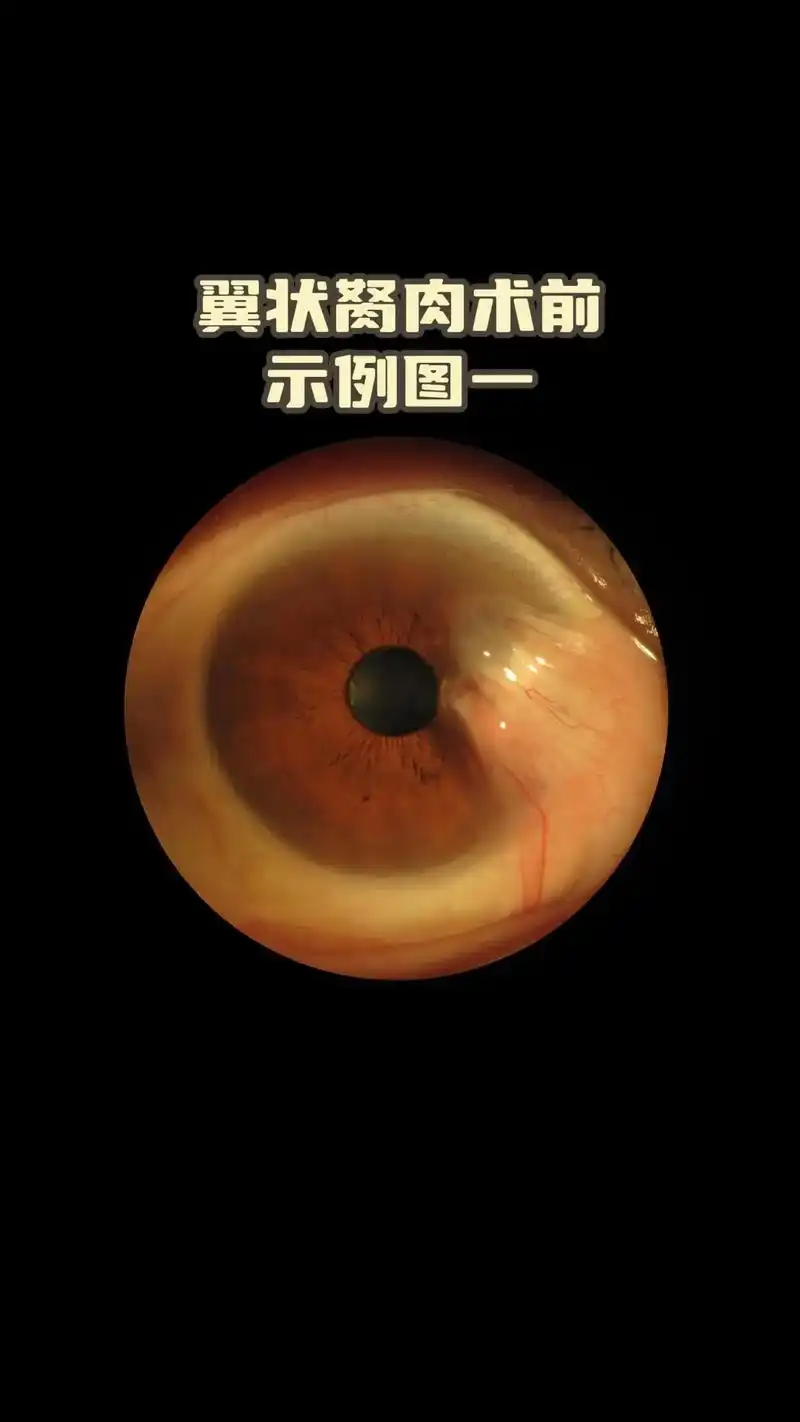 什么是翼状胬肉?眼睛里长东西,眼球上长了一坨肉是怎么回事 - 抖音
