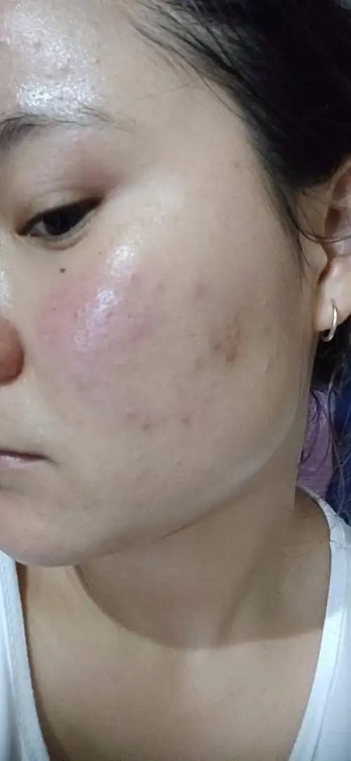 额头两边脸都长粉刺又是敏感肌t区爱出油皮肤很容易干鼻子还爱起皮有