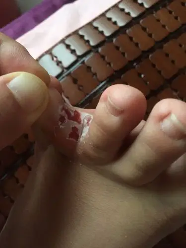 请问一下脚丫子烂的厉害怎么办啊!求答案,谢谢