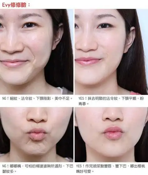 玻尿酸丰唇让嘟嘴女神昨日重现