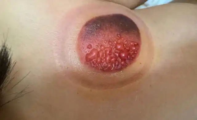 南昌一女子拨火罐被严重烫伤,全是水泡!店家竟说:是湿气