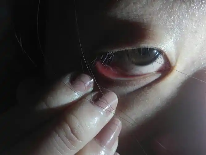 室友眼睛下眼皮发红 还有白色的东西 大神帮看看这是怎么了