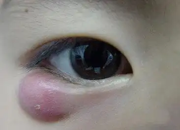 无自觉症状,睑皮下有结节隆起,无压痛与皮肤无粘连,翻转眼睑,正对囊肿