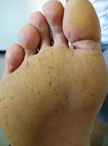 反复发作持续生长的双足底皮肤大面积角质化
