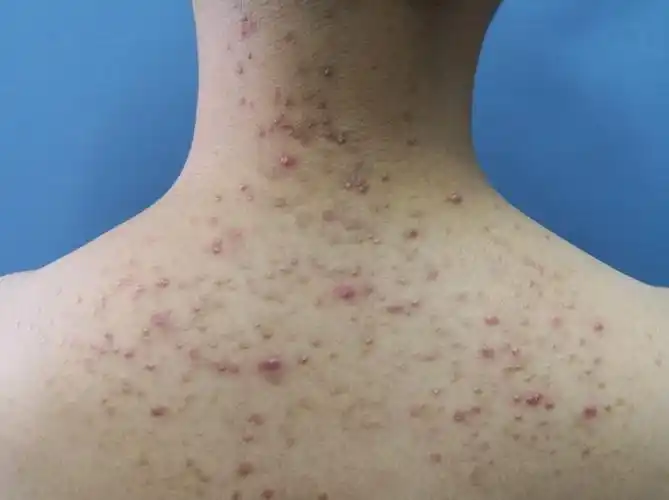 伪装成痘痘的糠秕孢子菌毛囊炎_毛囊炎 - 好大夫在线