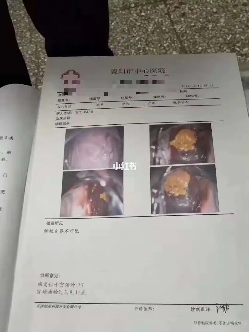 认识下什么宫颈癌